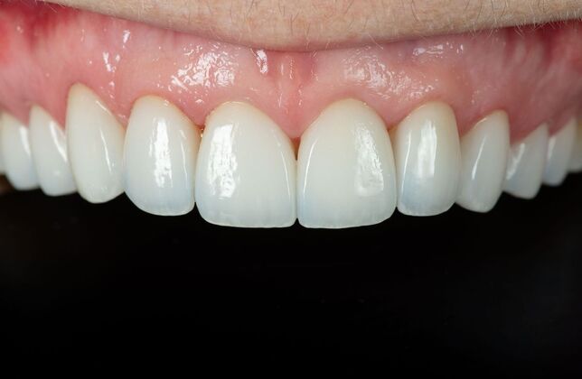 Full Mouth Rehabilitation: GS - After