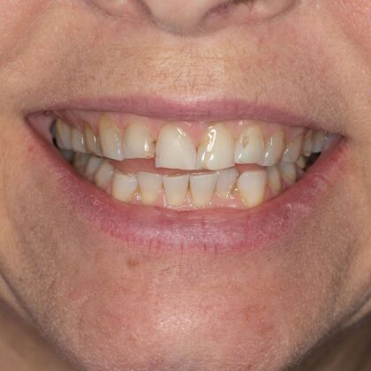 Full Mouth Rehabilitation: GS - Before