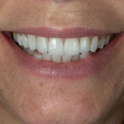 Full Mouth Rehabilitation: GS - After