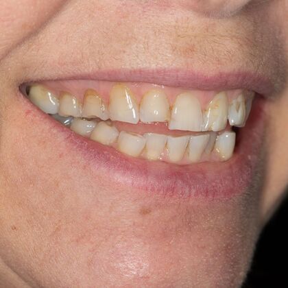 Full Mouth Rehabilitation: GS - Before