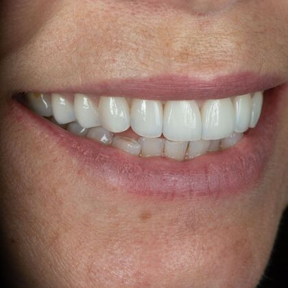 Full Mouth Rehabilitation: GS - After