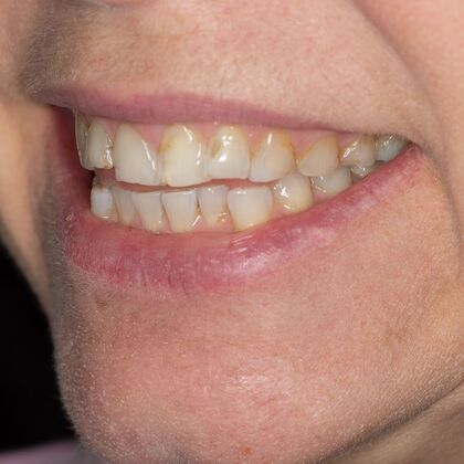 Full Mouth Rehabilitation: GS - Before