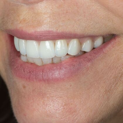 Full Mouth Rehabilitation: GS - After