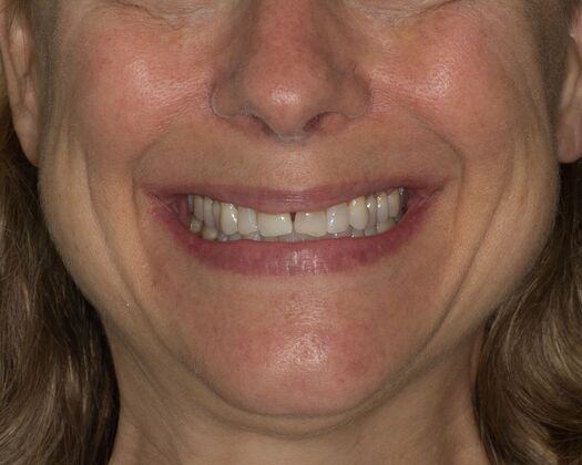 Porcelain Veneers: HL - Before