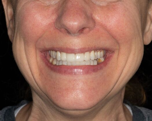 Porcelain Veneers: HL - After