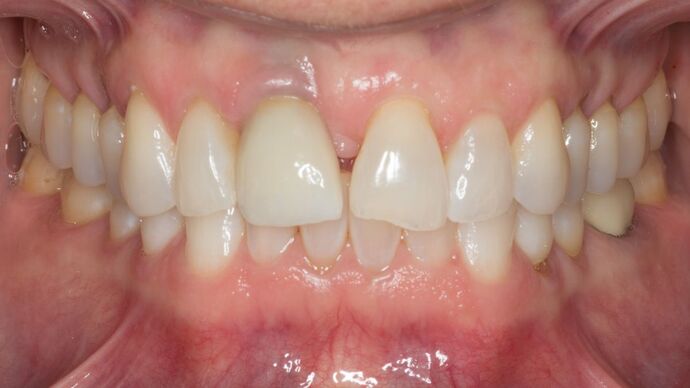 Porcelain Veneers: HL - Before