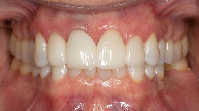 Porcelain Veneers: HL - After