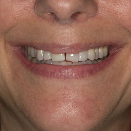 Porcelain Veneers: HL - Before