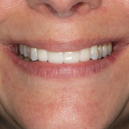 Porcelain Veneers: HL - After