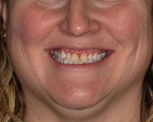 Porcelain Veneers: SM - Before