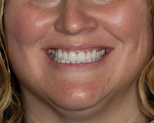 Porcelain Veneers: SM - After