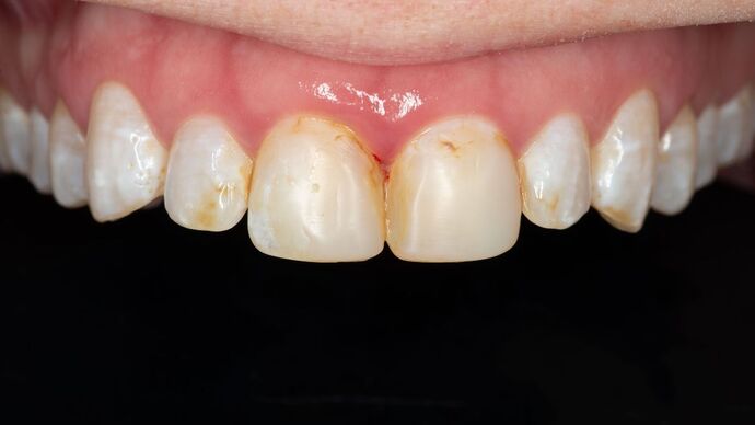 Porcelain Veneers: SM - Before