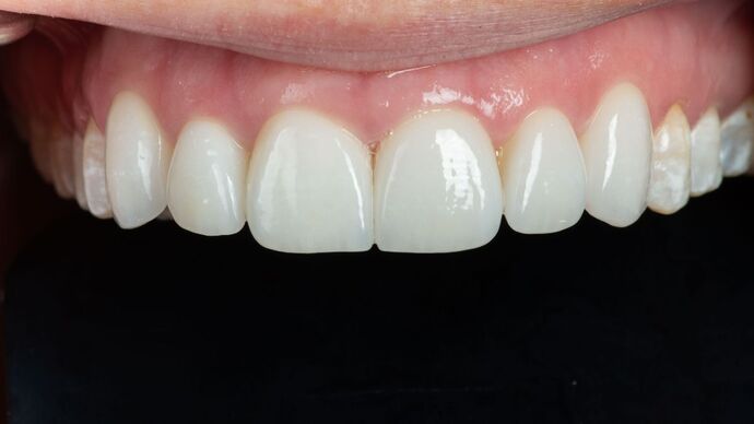 Porcelain Veneers: SM - After