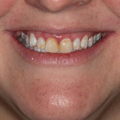 Porcelain Veneers: SM - Before