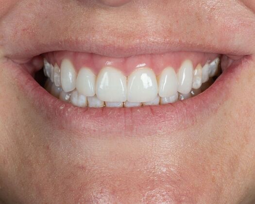 Porcelain Veneers: SM - After