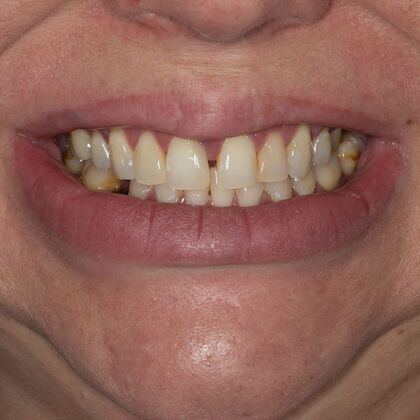 Porcelain Veneers: BO - Before