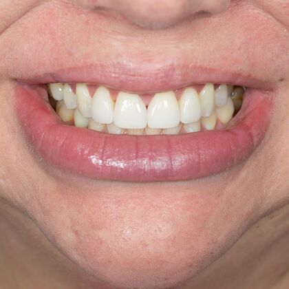 Porcelain Veneers: BO - After