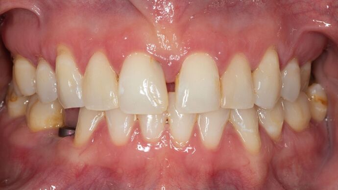 Porcelain Veneers: BO - Before
