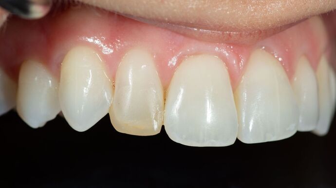 Dental Bonding: TG - Before
