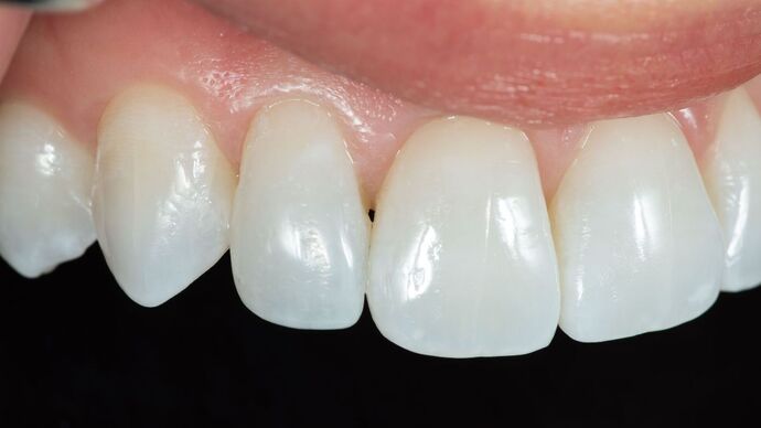 Dental Bonding: TG - After