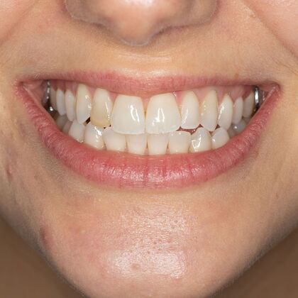 Dental Bonding: TG - Before