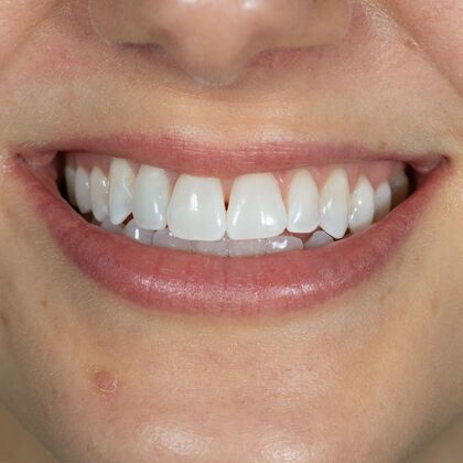 Dental Bonding: TG - After
