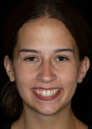 Dental Bonding: ED - Before