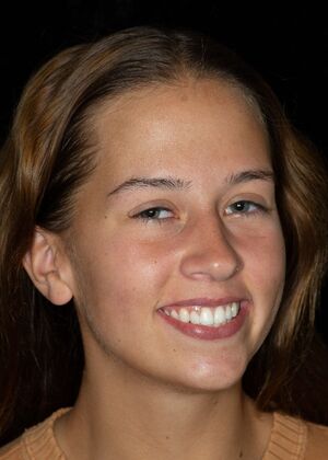 Dental Bonding: ED - After