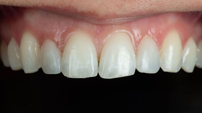 Dental Bonding: ED - After