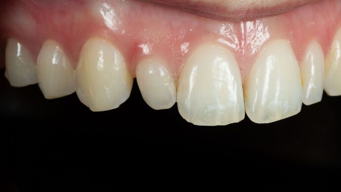 Dental Bonding: ED - Before