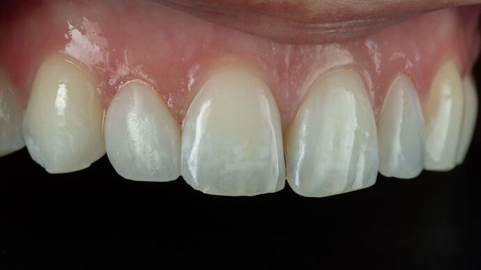 Dental Bonding: ED - After