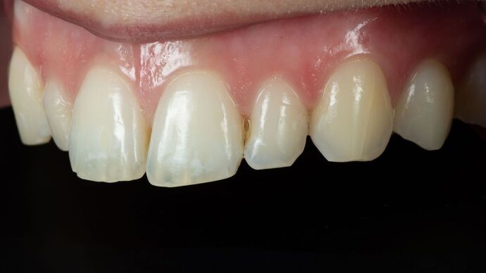 Dental Bonding: ED - Before