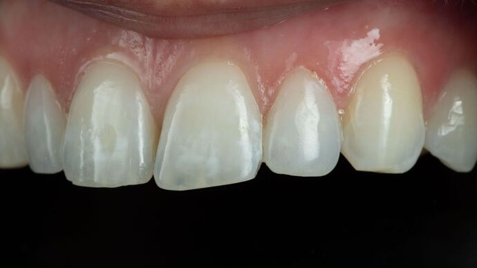 Dental Bonding: ED - After