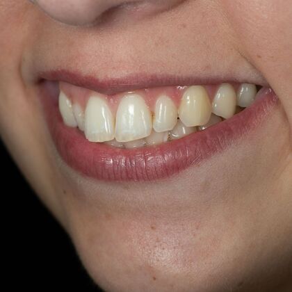 Dental Bonding: ED - Before