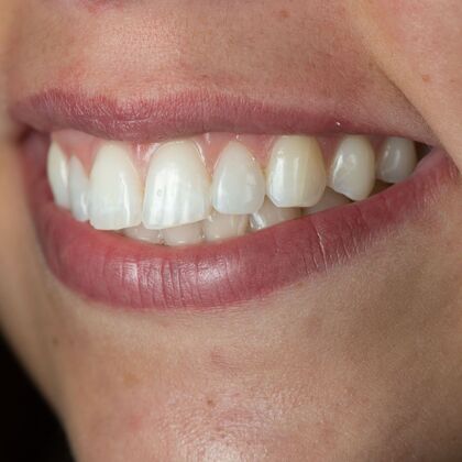 Dental Bonding: ED - After