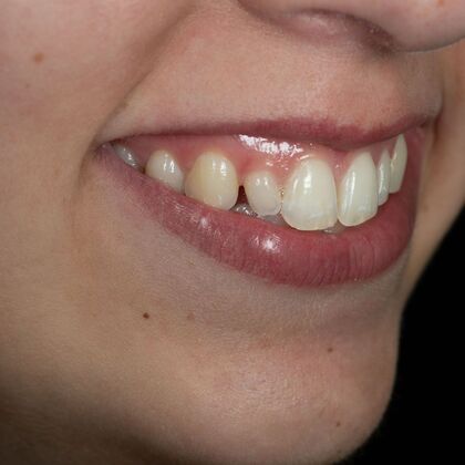 Dental Bonding: ED - Before