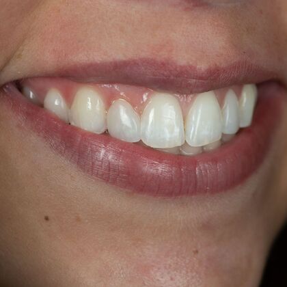 Dental Bonding: ED - After