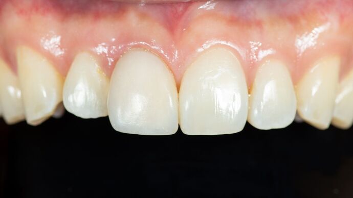 Dental Bonding: KY - After