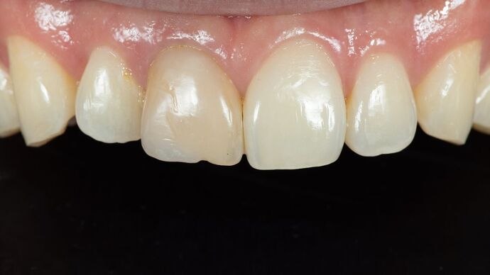 Dental Bonding: KY - Before