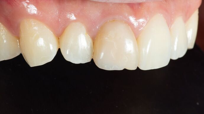 Dental Bonding: KY - Before