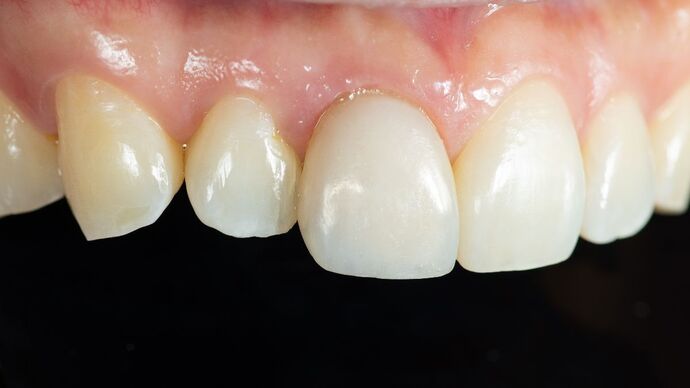 Dental Bonding: KY - After