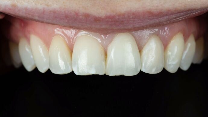 Dental Bonding: TM - After