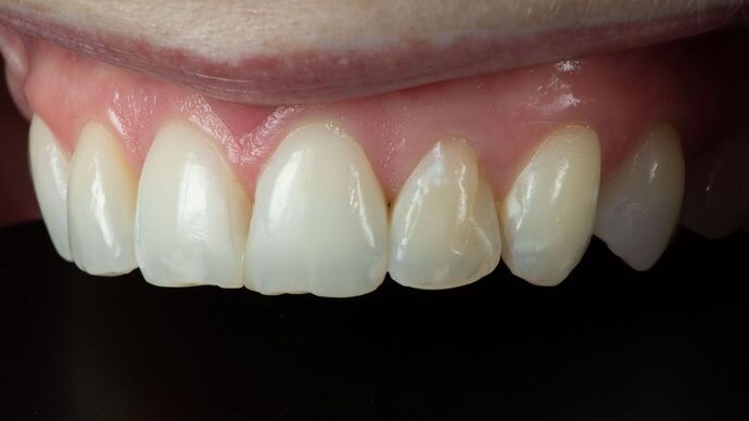 Dental Bonding: TM - Before