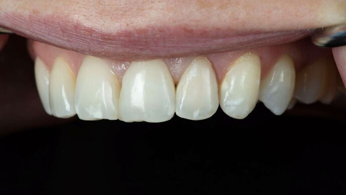 Dental Bonding: TM - After