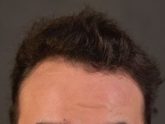 FUT Hair Restoration Case 32 - After