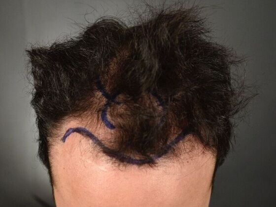 FUT Hair Restoration: Case 32 - Before