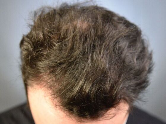 FUT Hair Restoration: Case 32 - After