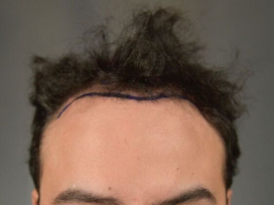 FUT Hair Restoration Case 32 - Before