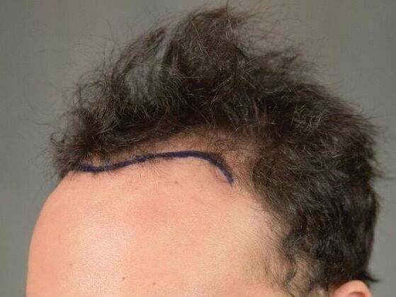 FUT Hair Restoration: Case 32 - Before