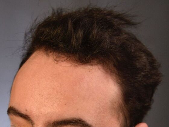 FUT Hair Restoration: Case 32 - After